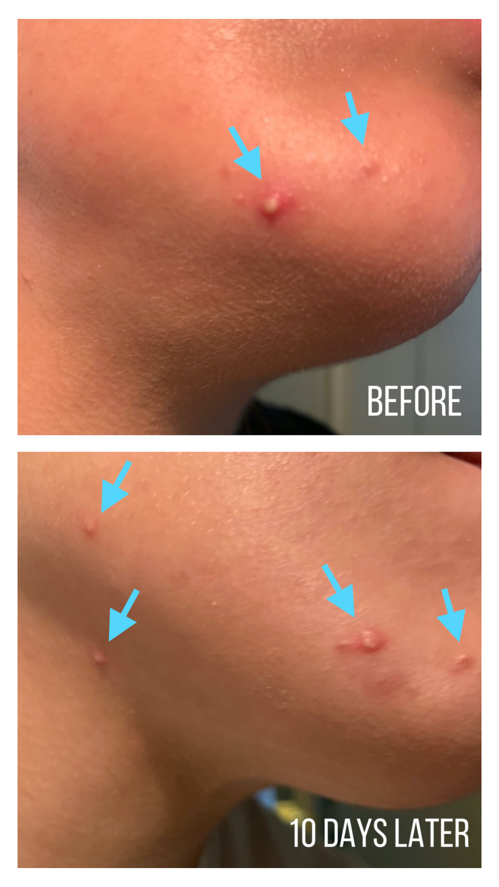 REVIEW] La Roche-Posay Effaclar Duo Acne Spot (Before and After) — DEWILDESALHAB武士