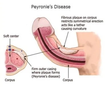 bpc 157 peyronie's disease Specialist Seattle WA Peyronie's Disease Archives - Vasectomy