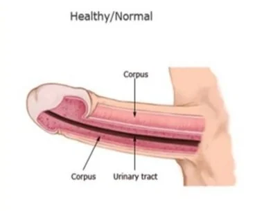 peyronie's forum acetyl l carnitine 2018 site www.peyroniesforum.net Stem Cells for Disease 4 Ways to Treat Peyronie's