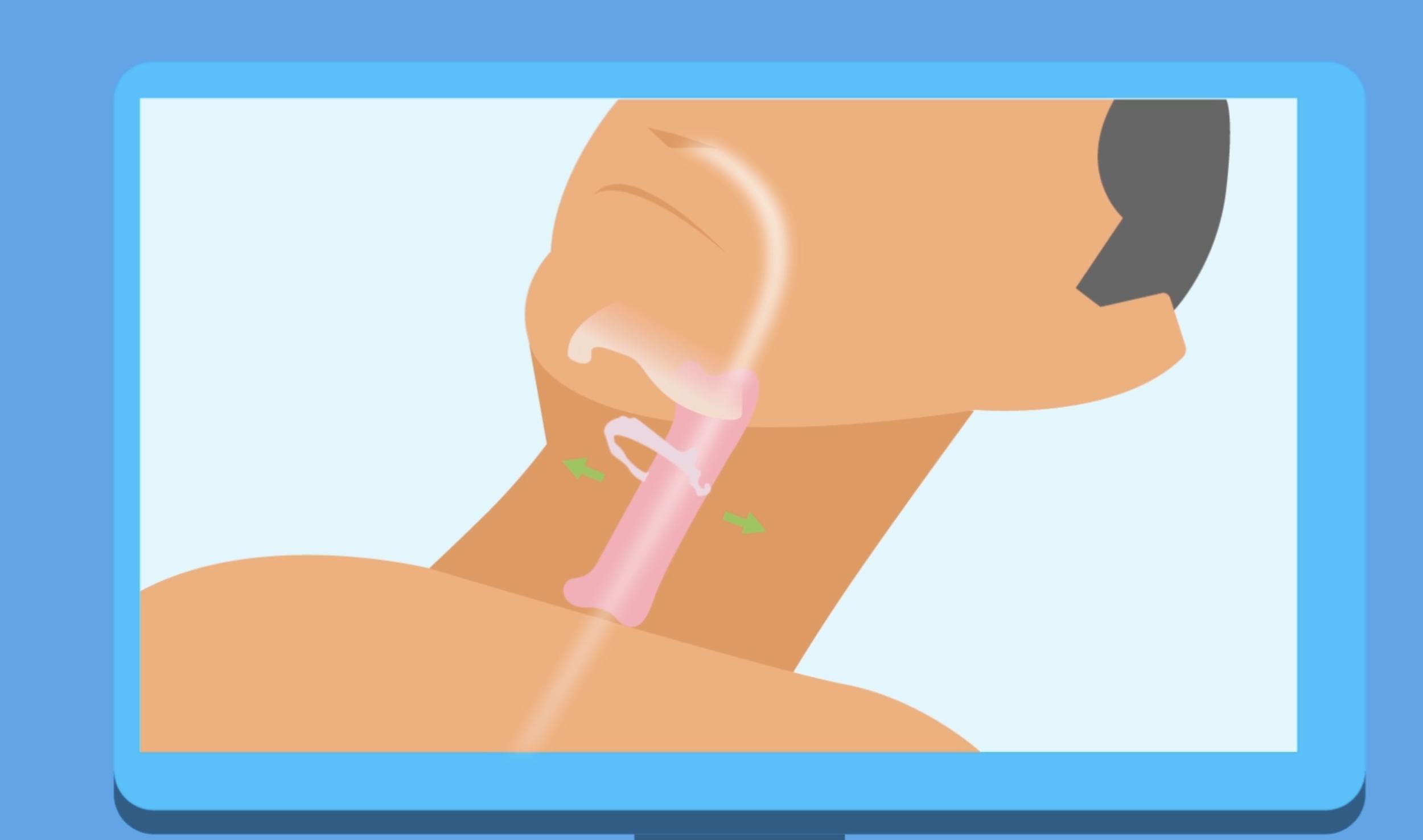 Utah Sleep Apnea Implant Surgery, Inspire Implant, Airlift Implant