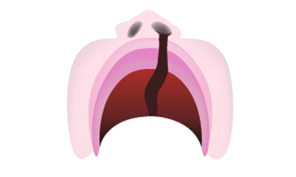 Unilateral Cleft Lip and Palate