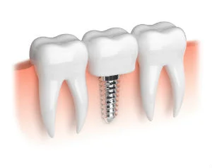 Gad_implants_foto_79782158_BB.jpg