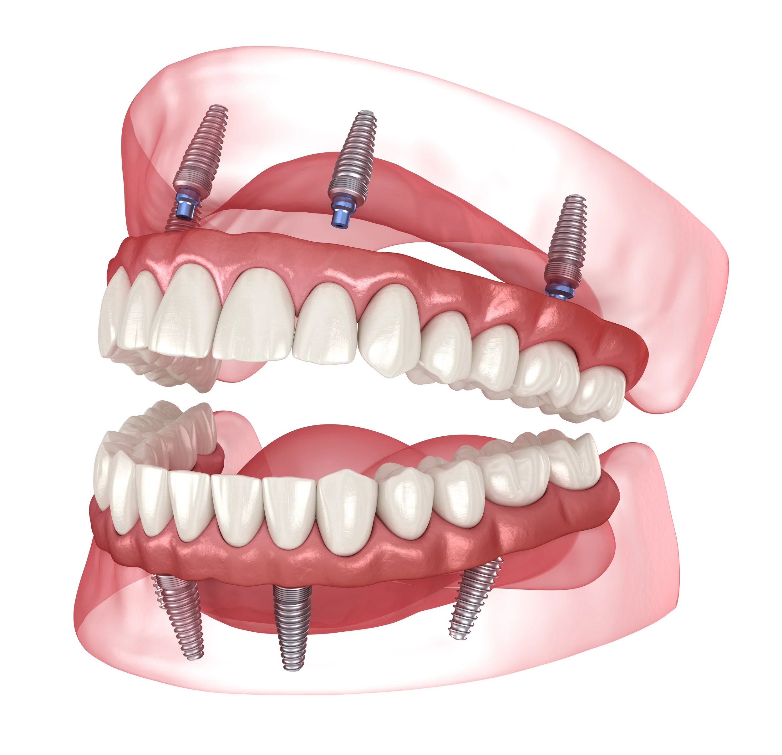 implant dentures Auckland