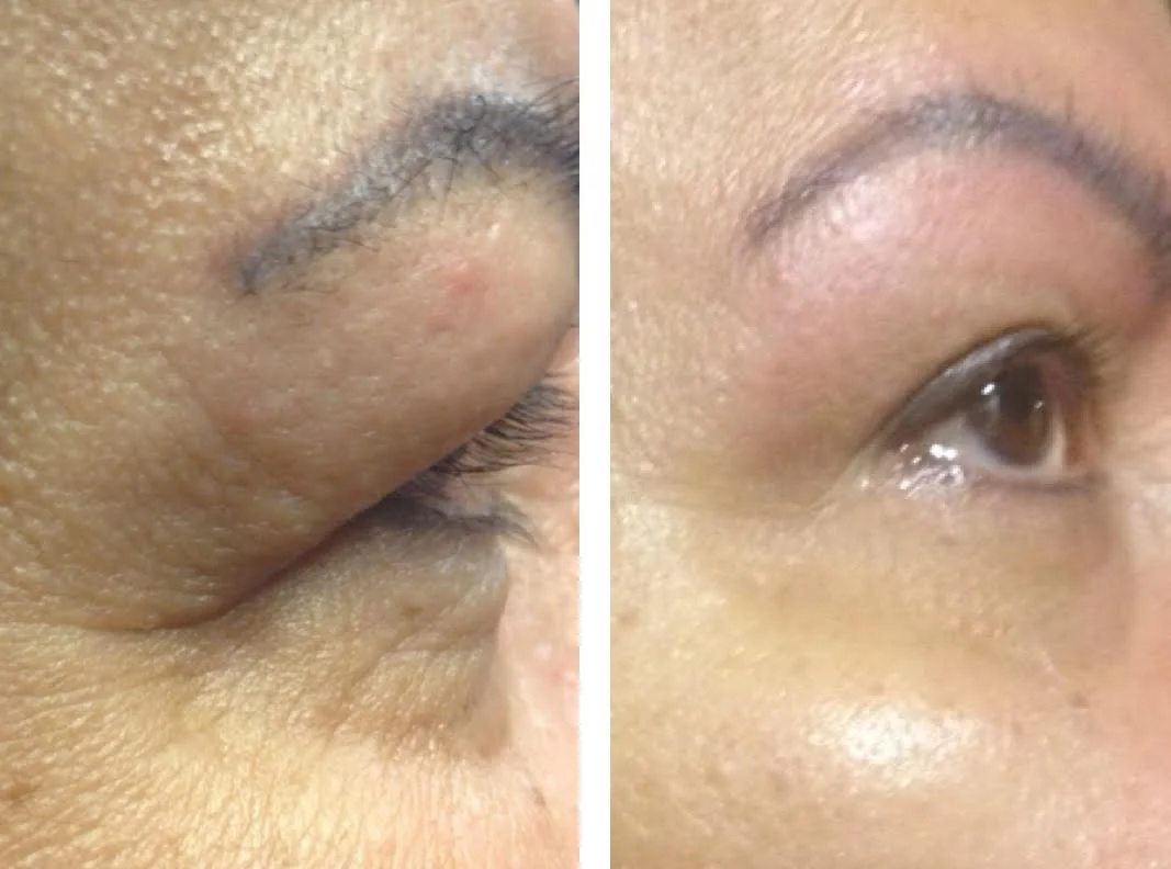 dermasound facial near me