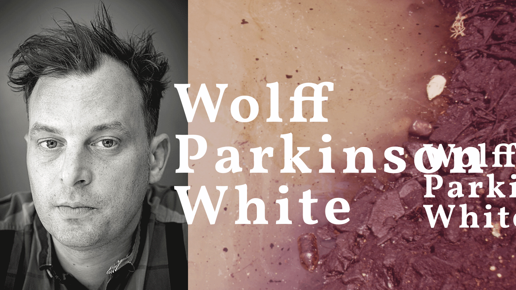 Wolff Parkinson White