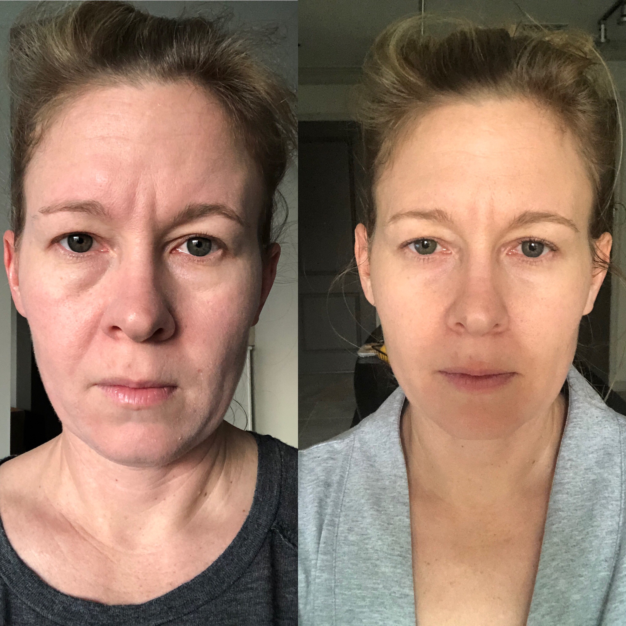 Pre- Surgery: Left ONE Day Post: Right Same light, same time of day, same camera.