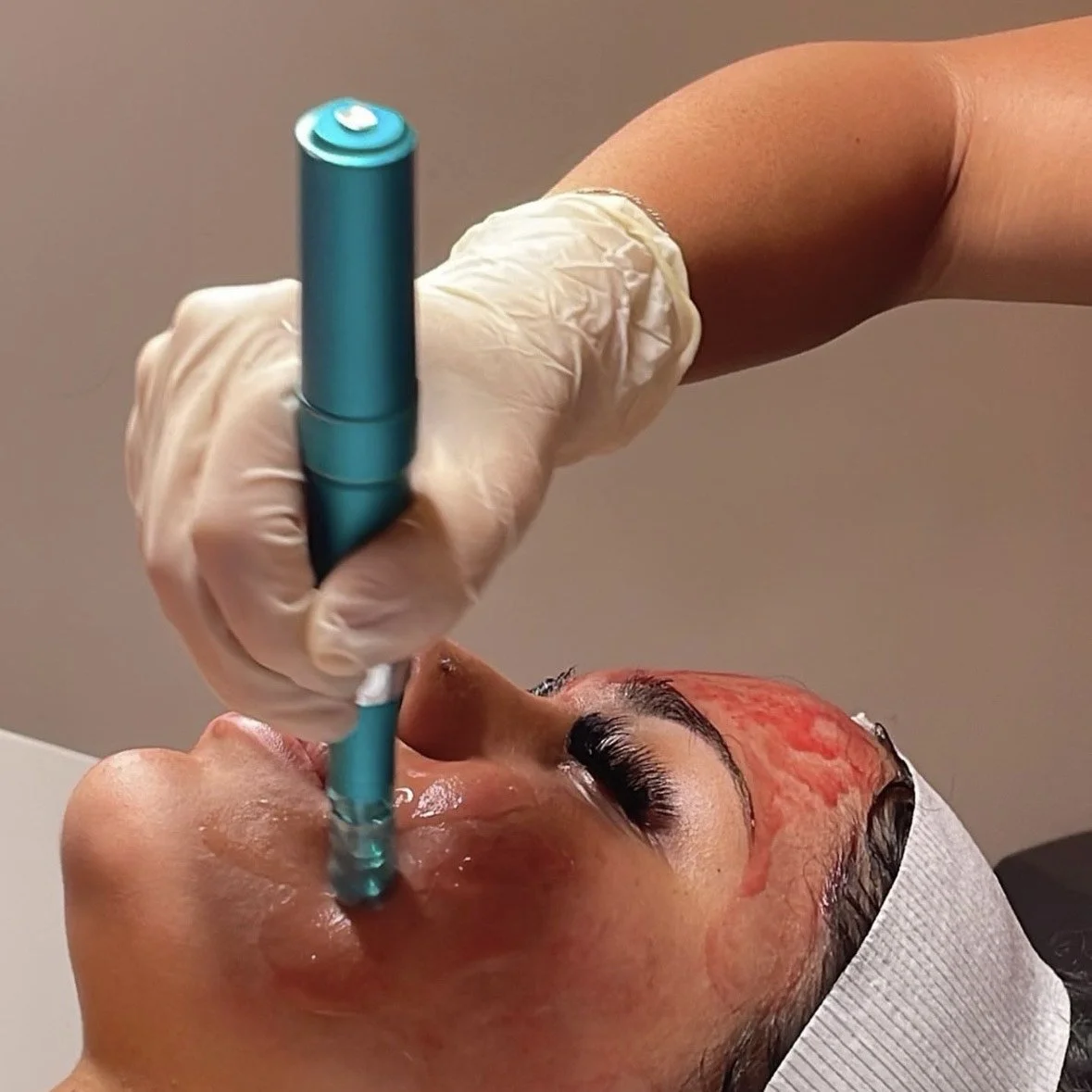SKIN NEEDLING
