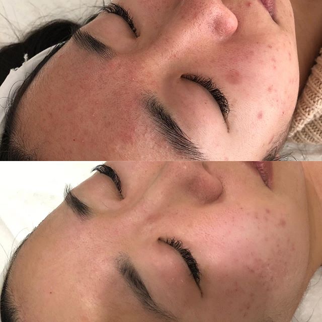 ✨Reduction of redness
✨Removal of pigmentation ✨Improved tone and texture ✨Improved skin function