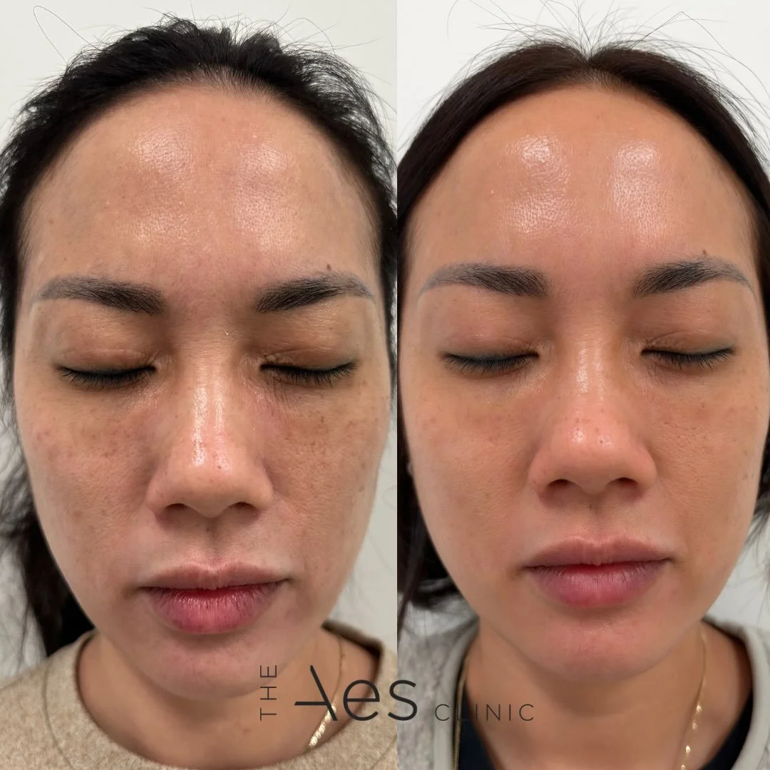 Two AuraLux sessions. Same skin, youthful, calmer and clearer.

Look closely at the cheeks. The scattered pigmentation has softened, the redness has settled, skin firmer and tighter and the texture looks smoother and more refined. No filter, no makeu