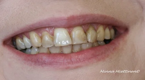 Teeth before veneers.