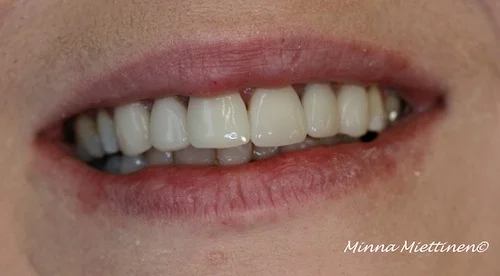 Teeth with veneers.