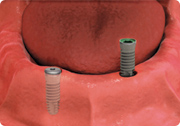 overdentures1.png