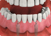 overdentures3.png