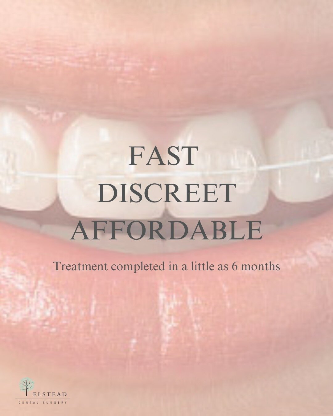 A brand new smile, in a little as 6 months... 

We get it, the thought of having braces for 2/3 years doesn't sound ideal! That's why at Elstead Dental, we use Cfast&reg; cosmetic braces as an alternative to conventional braces and a simple and affor