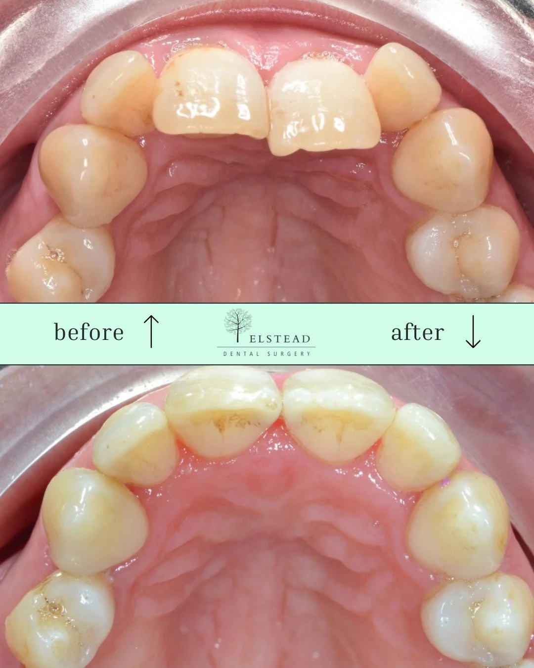 ✨ Want a straighter smile, fast? ✨

Our Cfast braces and aligners focus only on your front teeth. 
By skipping the lengthy process of moving every tooth, Cfast delivers results in a fraction of the time!

✨ Straighter, more confident smile - quicker 