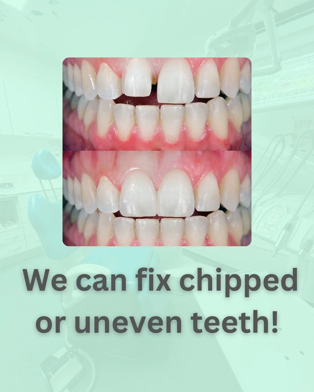 β¨ Transform Your Smile with Veneers! β¨
Did you know that we offer custom-made veneers to help you achieve a beautiful, natural smile? 
Whether you're looking to improve the colour, shape, or position of your teeth, veneers could be the perfect solu