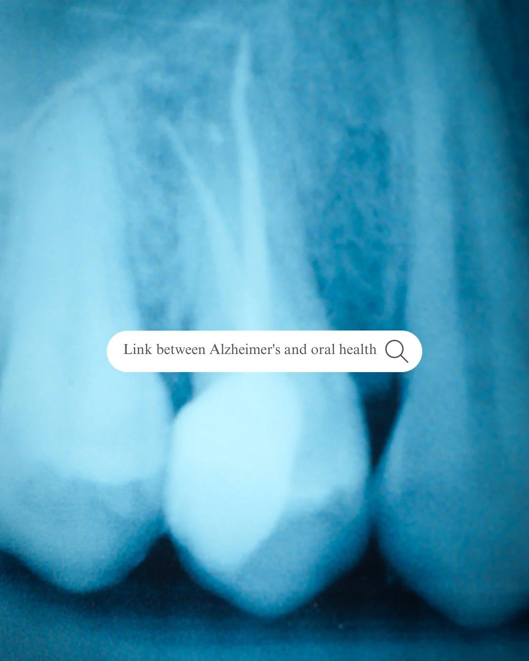 Did you know there’s a link between gum health and cognitive decline, particularly Alzheimer's disease? π§ π¦·
Harmful bacteria from dental plaque can spread from your gums to other areas of your body, potentially impacting your overall health.