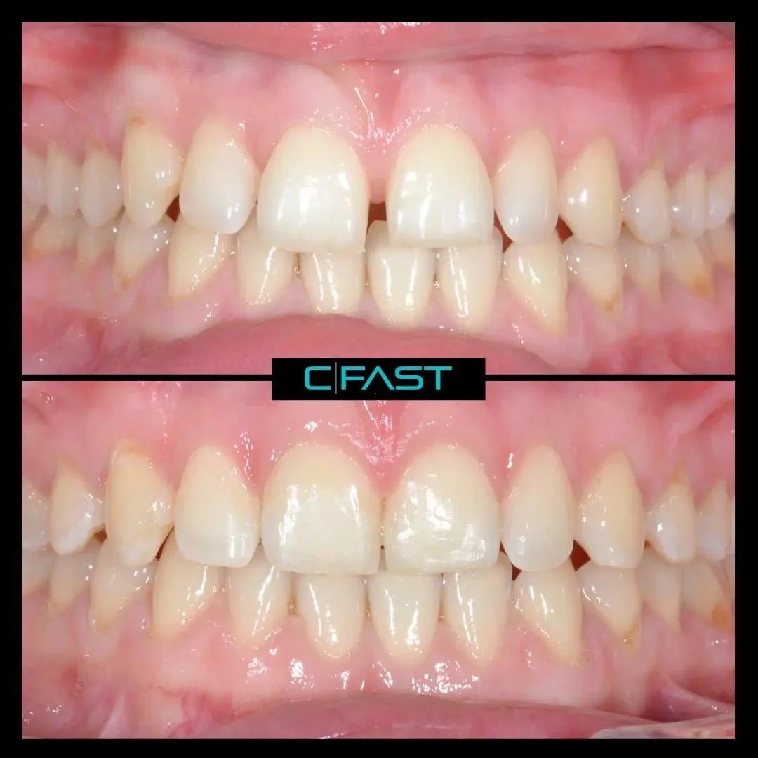 ✨ Thinking about straightening your smile? Let&rsquo;s make it happen. ✨

Cfast braces offer a fast, discreet and affordable way to align your front teeth, perfect for boosting confidence without the big orthodontic commitment.

Why our patients love