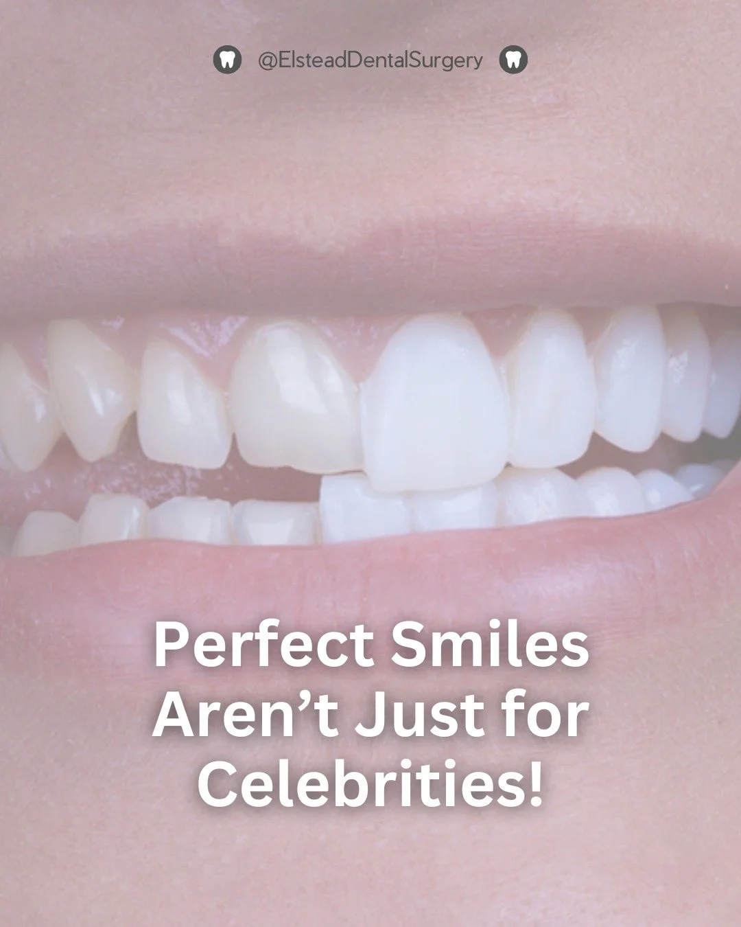 ✨ That Hollywood smile? Veneers can help! 
Fix chips, close gaps, or brighten your smile with a simple, effective solution.

💫 Ready for your smile makeover? Book your consultation.