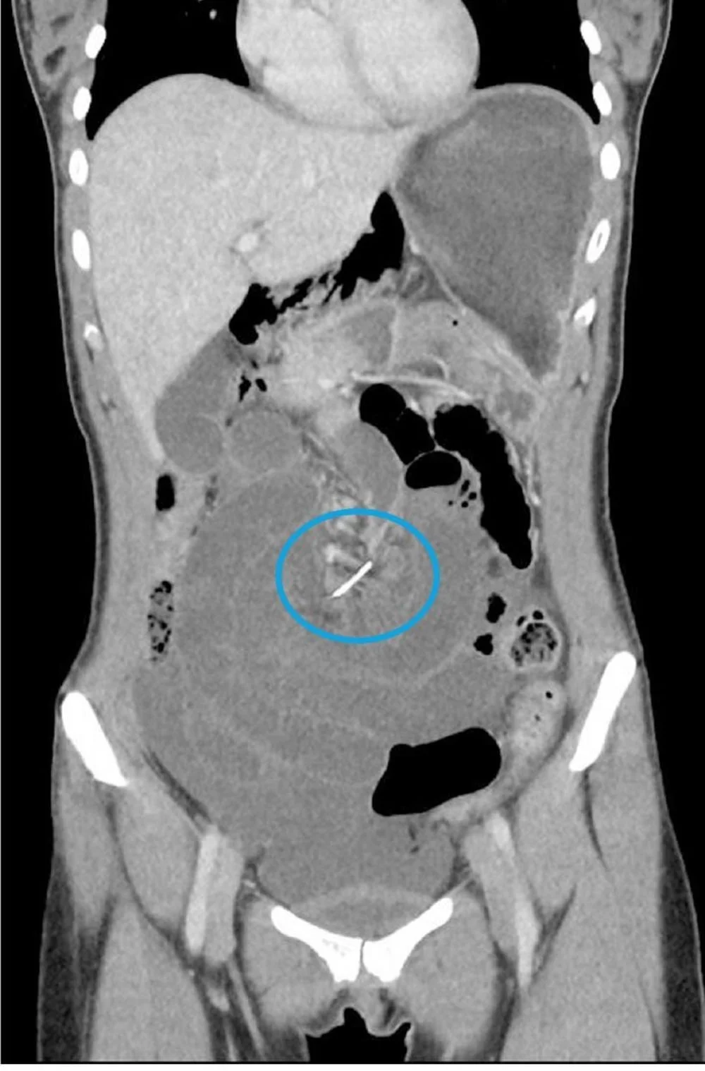 Dental brace wire lodged in intestine for a decade, doctors say