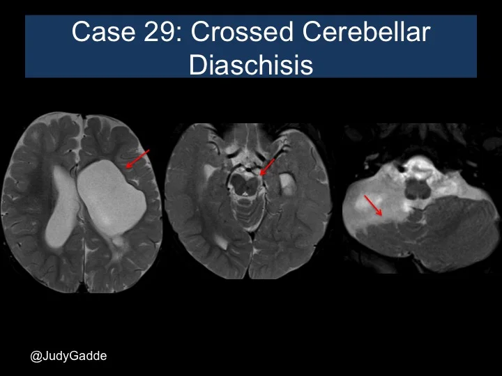 Case 29 Neuroradiologyu
