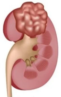 niertumor.jpg