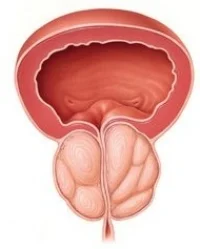 BPH.jpg