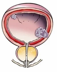 bladder-with-cancer.jpg