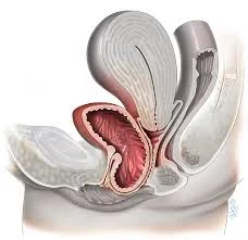 cystocoele.jpg
