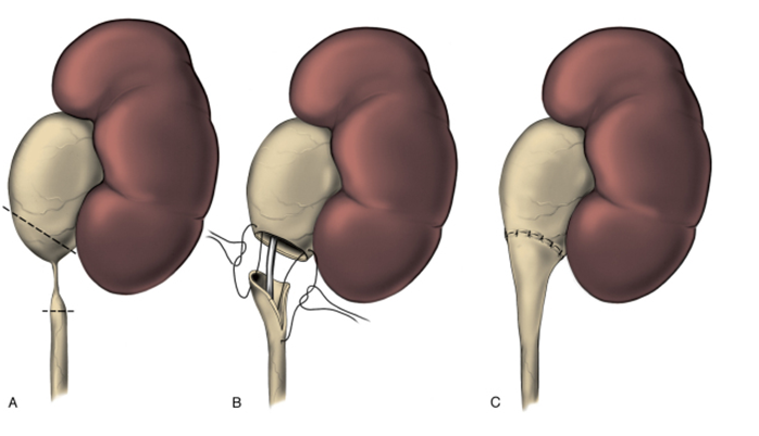 pyeloplastie.png