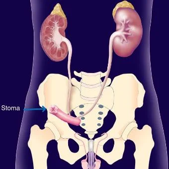 cystectomie-Bricker.jpg