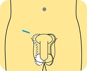 orchidectomy.gif