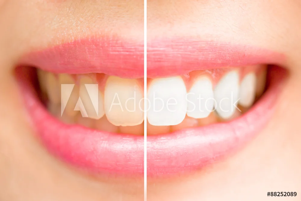 Teeth Whitening