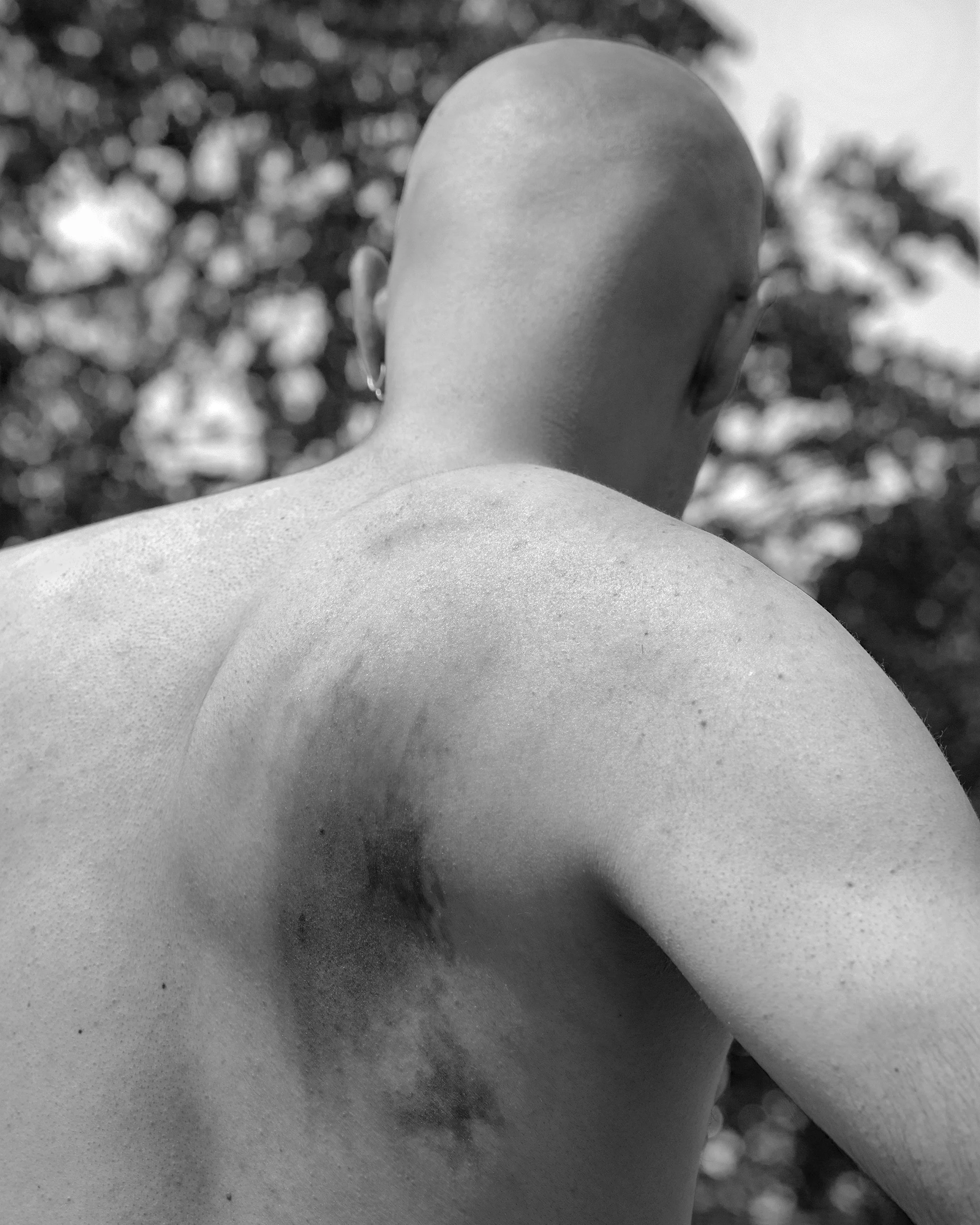 Keloid, 2020