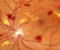 Renton+Vision+Clinic+Diabetiic+Retinopathy.jpg