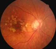 Renton+Vision+Clinic+macular+Degeneration.jpg