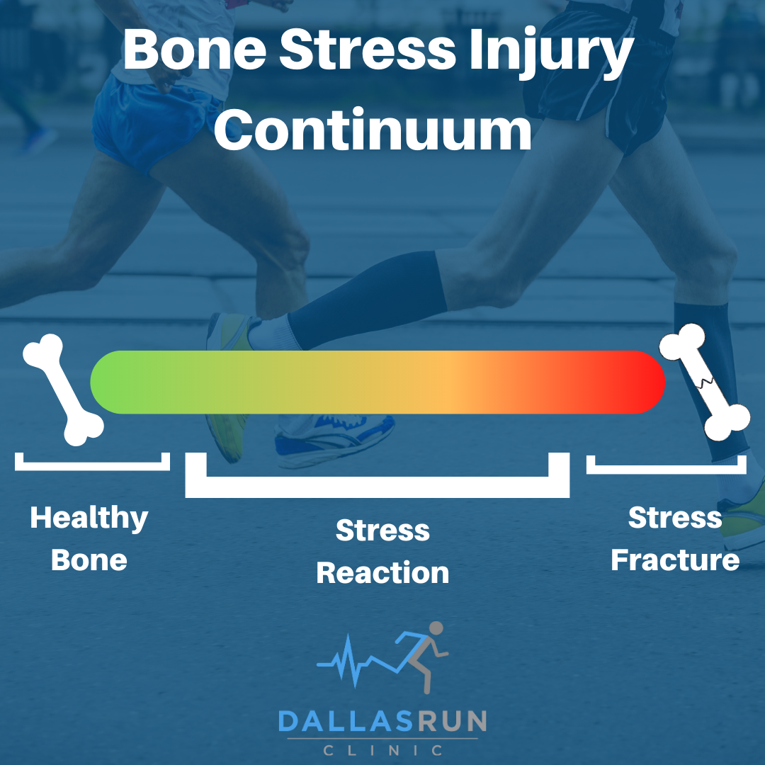 Bone Stress Injury Basics — Dallas Run Clinic