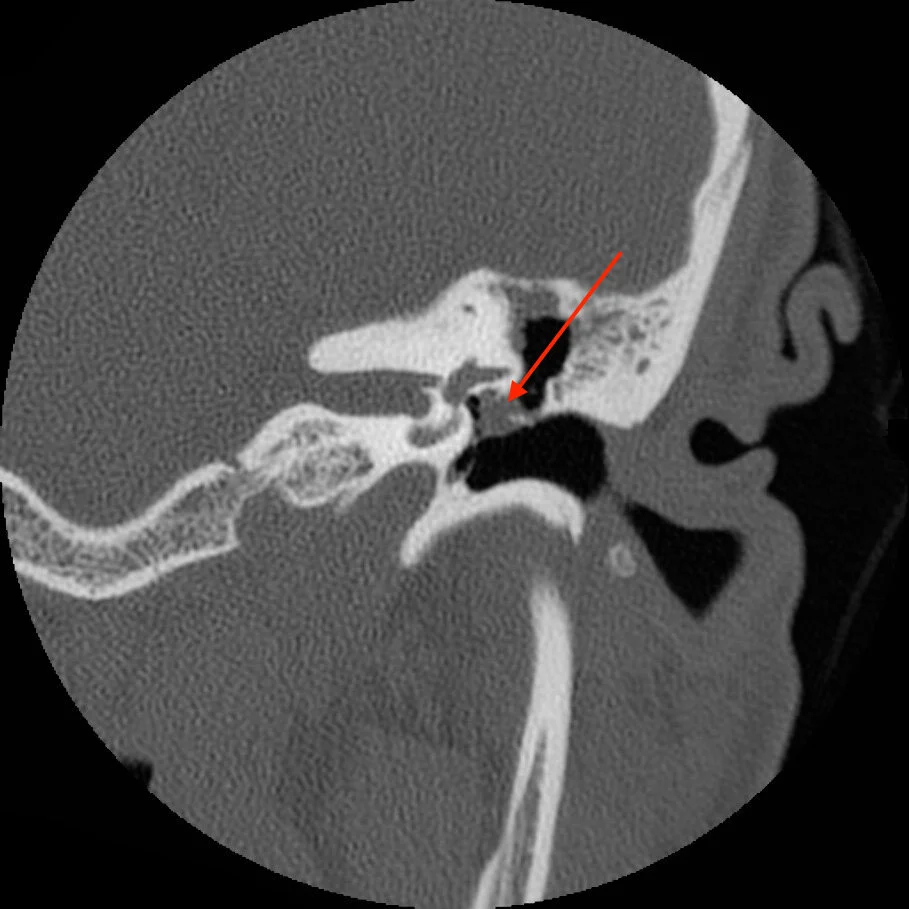 Cholesteatoma — Chad Ruffin, MD