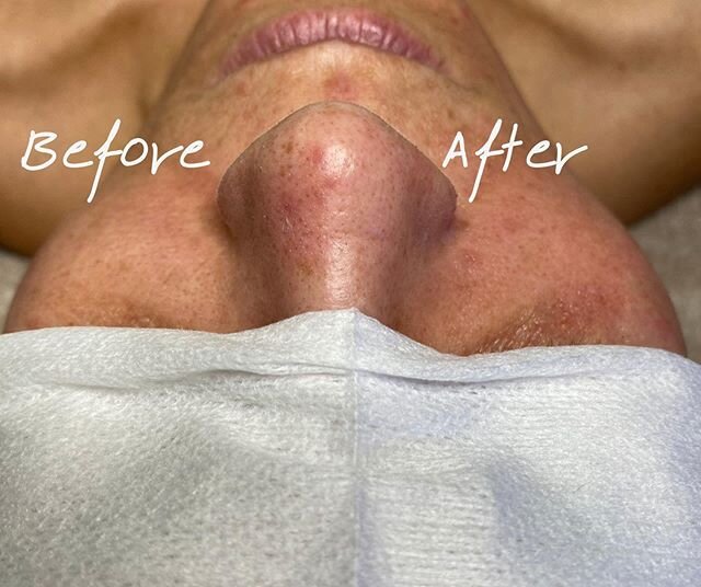 Why blackheads don&rsquo;t stand a chance during the Hydrafacial👇
🌀Skin has been deep cleaned
🌀Exfoliated physically
🌀Chemically exfoliated with glycolic/salicylic blend
🌀Your esti is a pro at extractions🤪

Try the Hydrafacial on your next faci