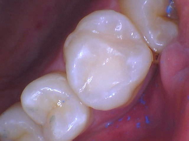 Bonding gaps between teeth with high end composite resins.