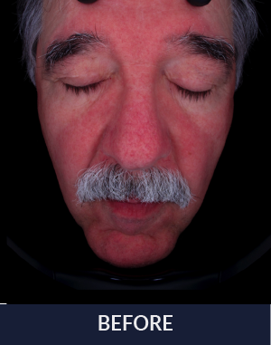 ADVaTx_Navy_Before_Rosacea.png