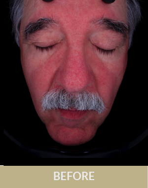 ADVaTx_Gold_Before_Rosacea.png