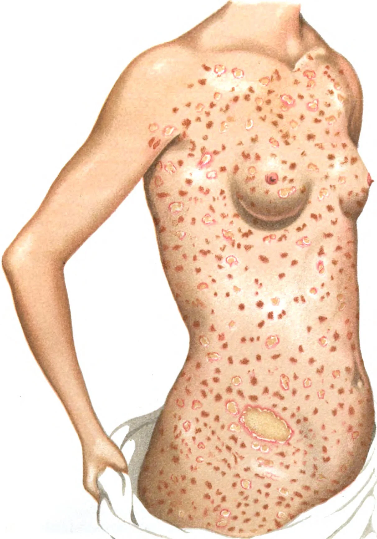 Pityriasis rosea gpraj