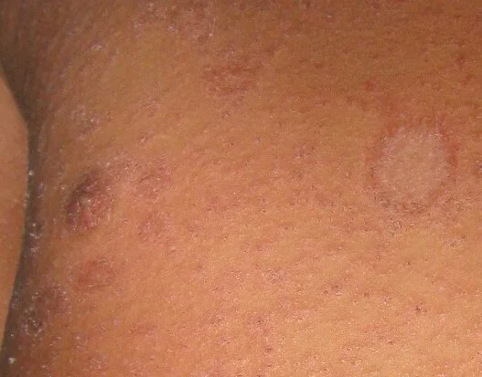 Pityriasis rosea — gpraj