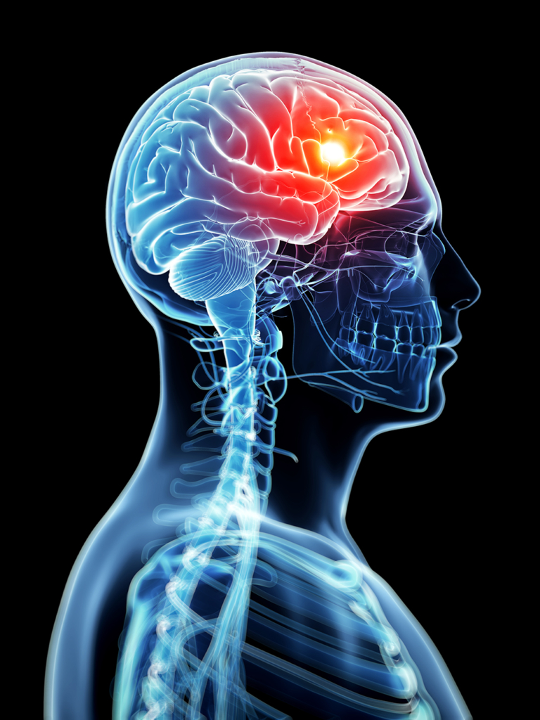migraine-headache-768x1024.jpeg