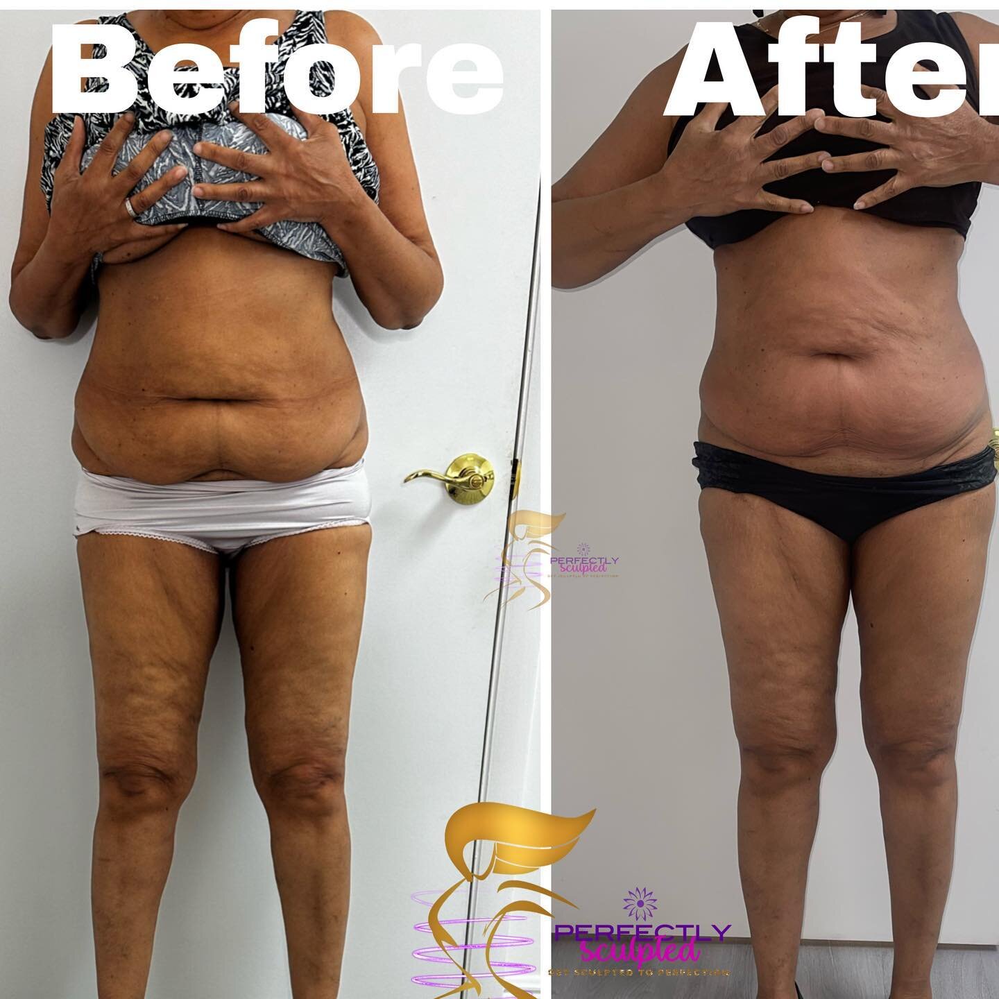 This client has been doing non surgical Skin Tightening with us . #nonsurgical #bodysculpting #rfskintightening #westpalmbeach #florida