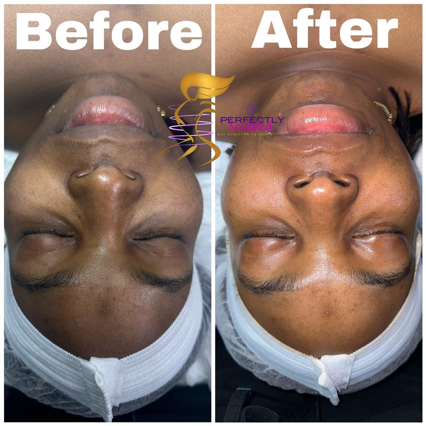 Derma-planing Facial , WOW 🤩Look at the instant glow. Here @perfectlysculptedwpb we provide you with top of the line luxury Facials. #esthetician #facials #spa #westpalmbeach #fyp #facecare