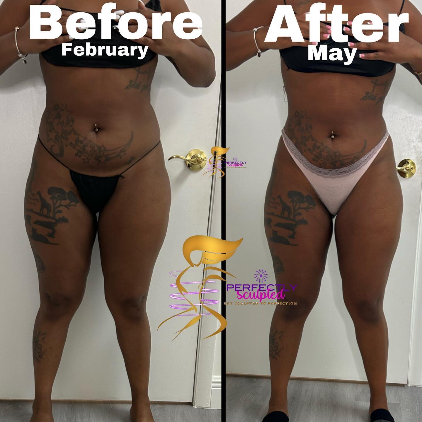 Wow ‼️‼️ look at this 4 month transformation 😁‼️❤️ NON SURGICAL BODY SCULPTING WORKS .