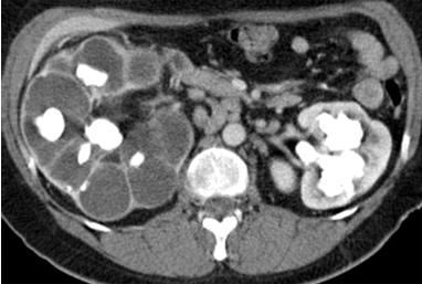 kidney-stone-laser-treatment-chennai.png