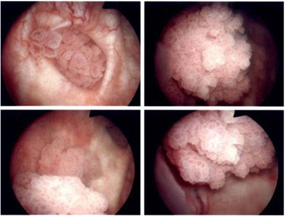 bladder-cancer-2.png